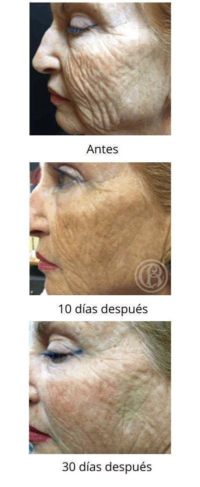 Bioregeneración Facial