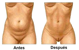 abdominoplastia antes y después