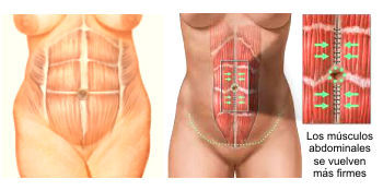 abdominoplastia músculos firmes
