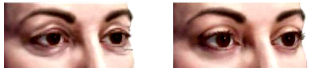 correccion párpados o blefaroplastia