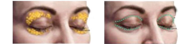 cirugía párpados o blefaroplastia