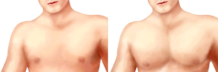 prótesis de pectorales en hombres