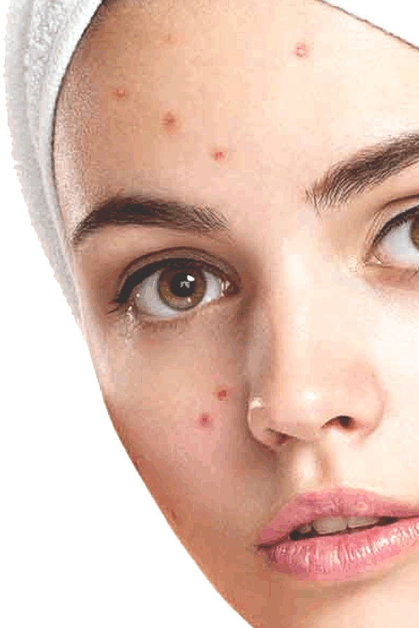 Tratamiento acne - disfunción dermatológica frecuente